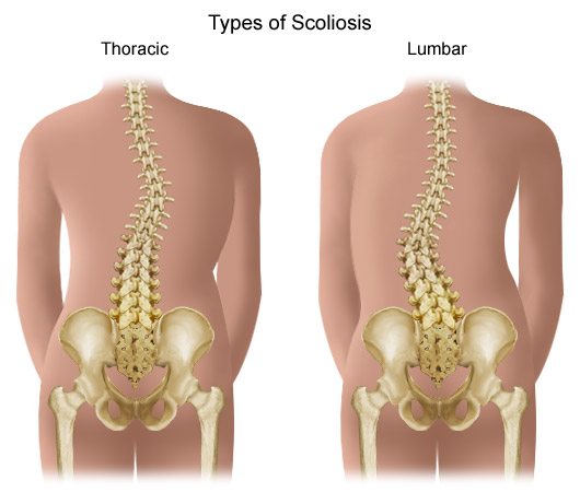 SCOLIOSIS kids teens and adults