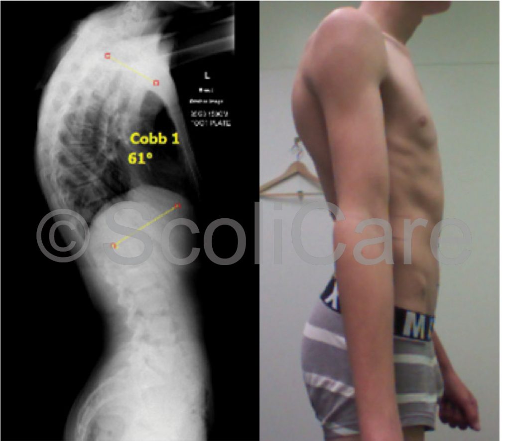 Case Study Kyphosis Bracing Scoliosis Clinic UK Treating Scoliosis Without Surgery