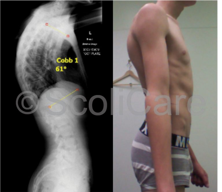 Case study Kyphosis Bracing Scoliosis Clinic UK Treating Scoliosis without surgery