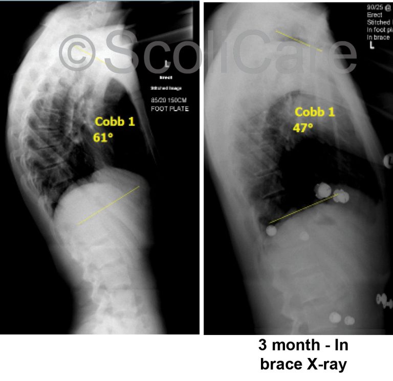 Case Study: Kyphosis Bracing - Scoliosis Clinic UK - Treating Scoliosis ...