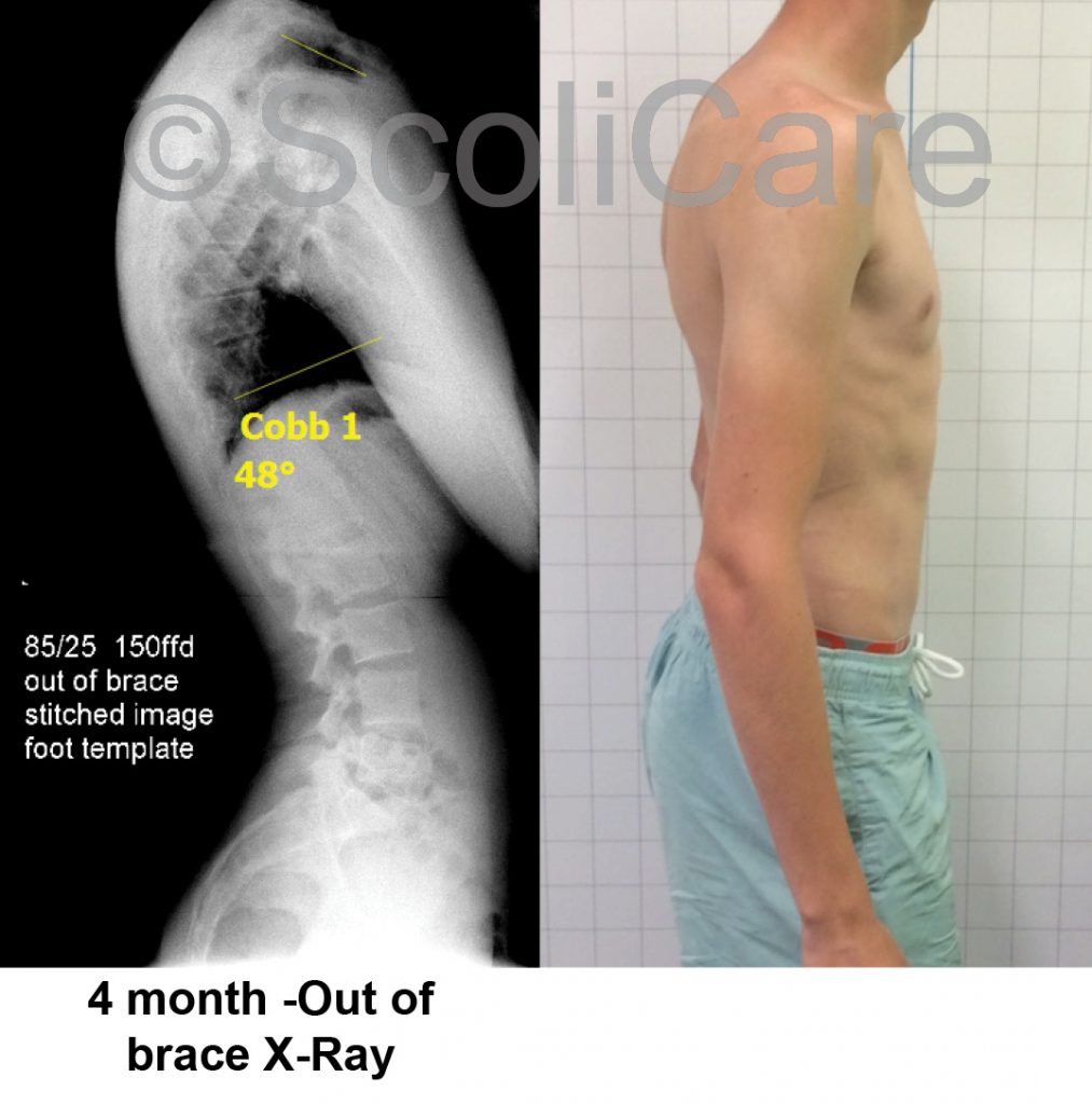 Graphic B Results Scoliosis Clinic Uk Treating Scoliosis Without Surgery