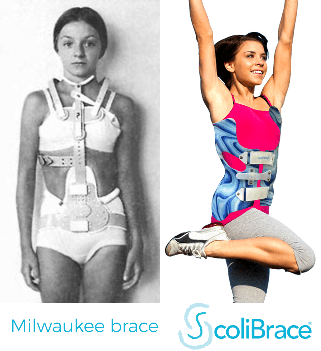 https://scoliosisclinic.co.uk/wp-content/uploads/2017/12/milwaukee-vs-scolibrace.png