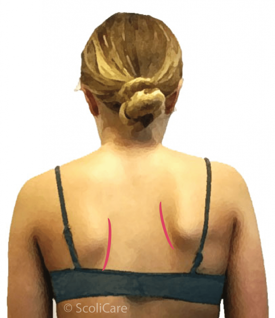 How can I check for Scoliosis? Scoliosis Clinic UK Treating