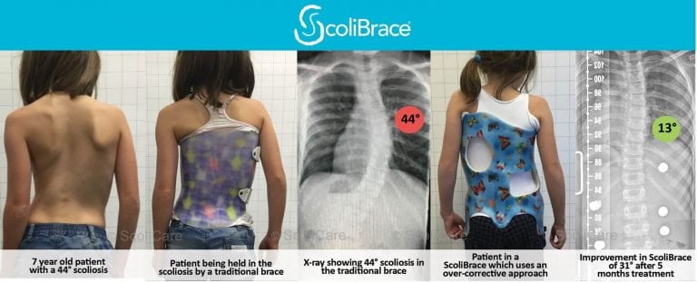 Scoliosis Treatment Archives Page Of Scoliosis Clinic UK Treating Scoliosis Without