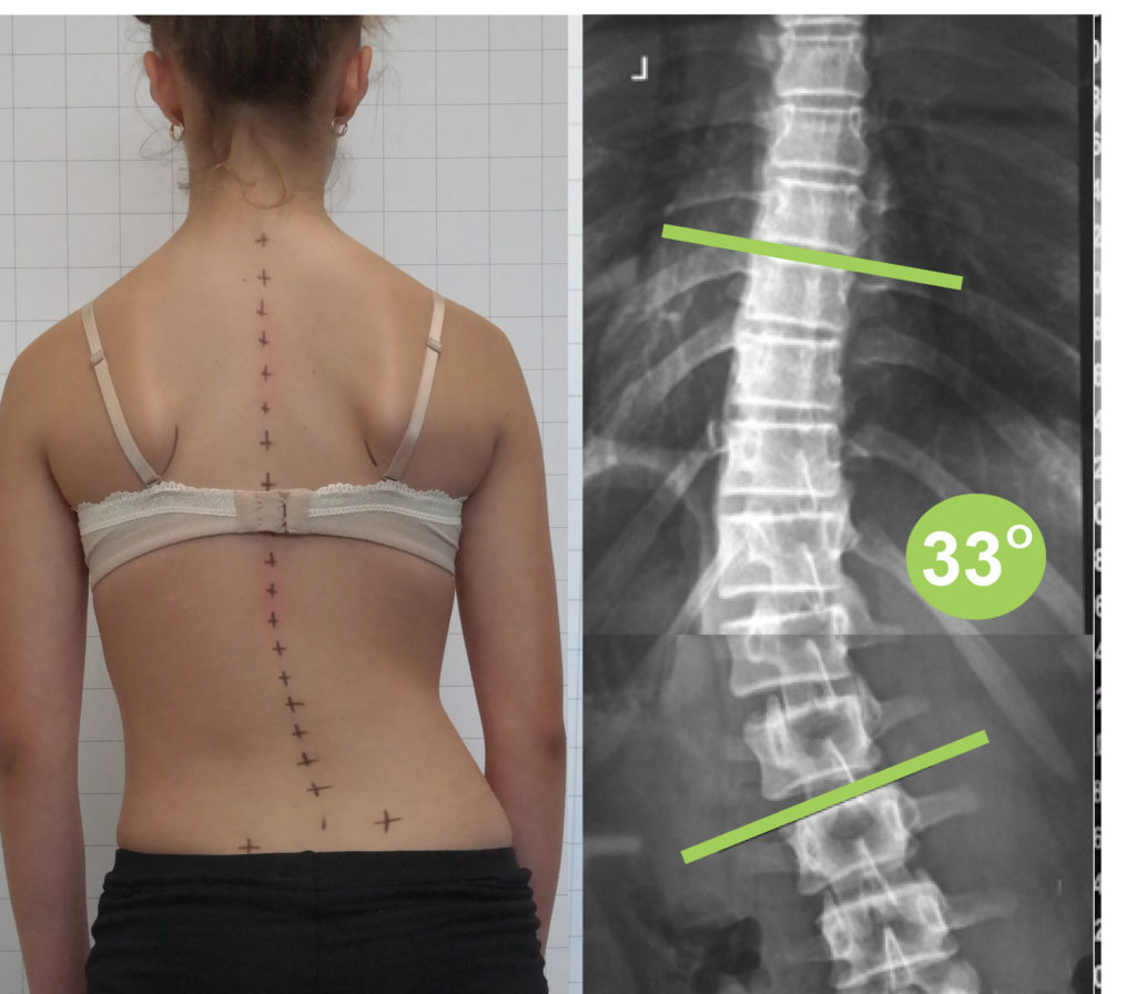 How To Sport Scoliosis Archives Scoliosis Clinic Uk Treating Scoliosis Without Surgery