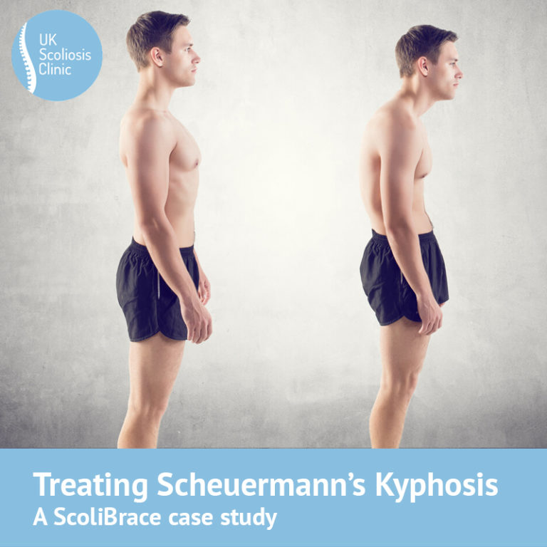 Scheuermanns Archives Scoliosis Clinic Uk Treating Scoliosis Without Surgery 2008