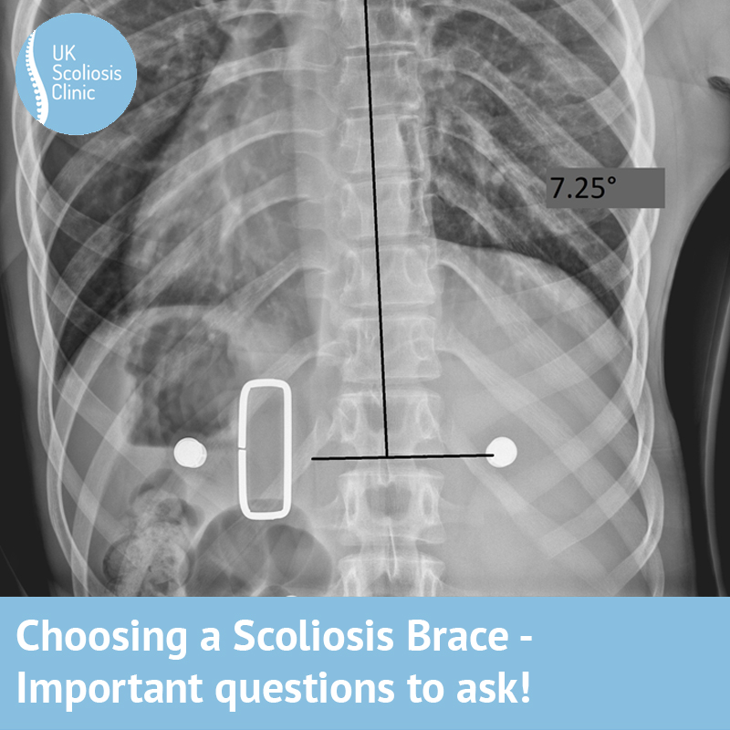 Boston Brace: First Check before X-Ray - Scoliosis and Spine Online Learning