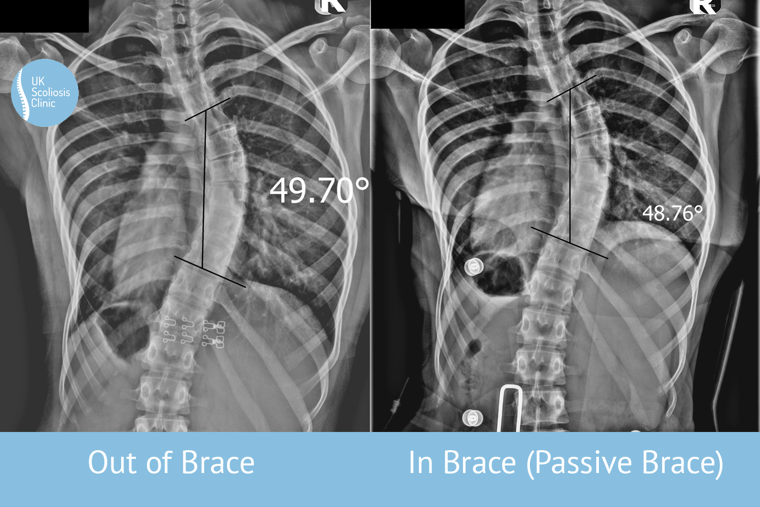 Scoliosis Braces: Can Scoliosis be Corrected with a Brace