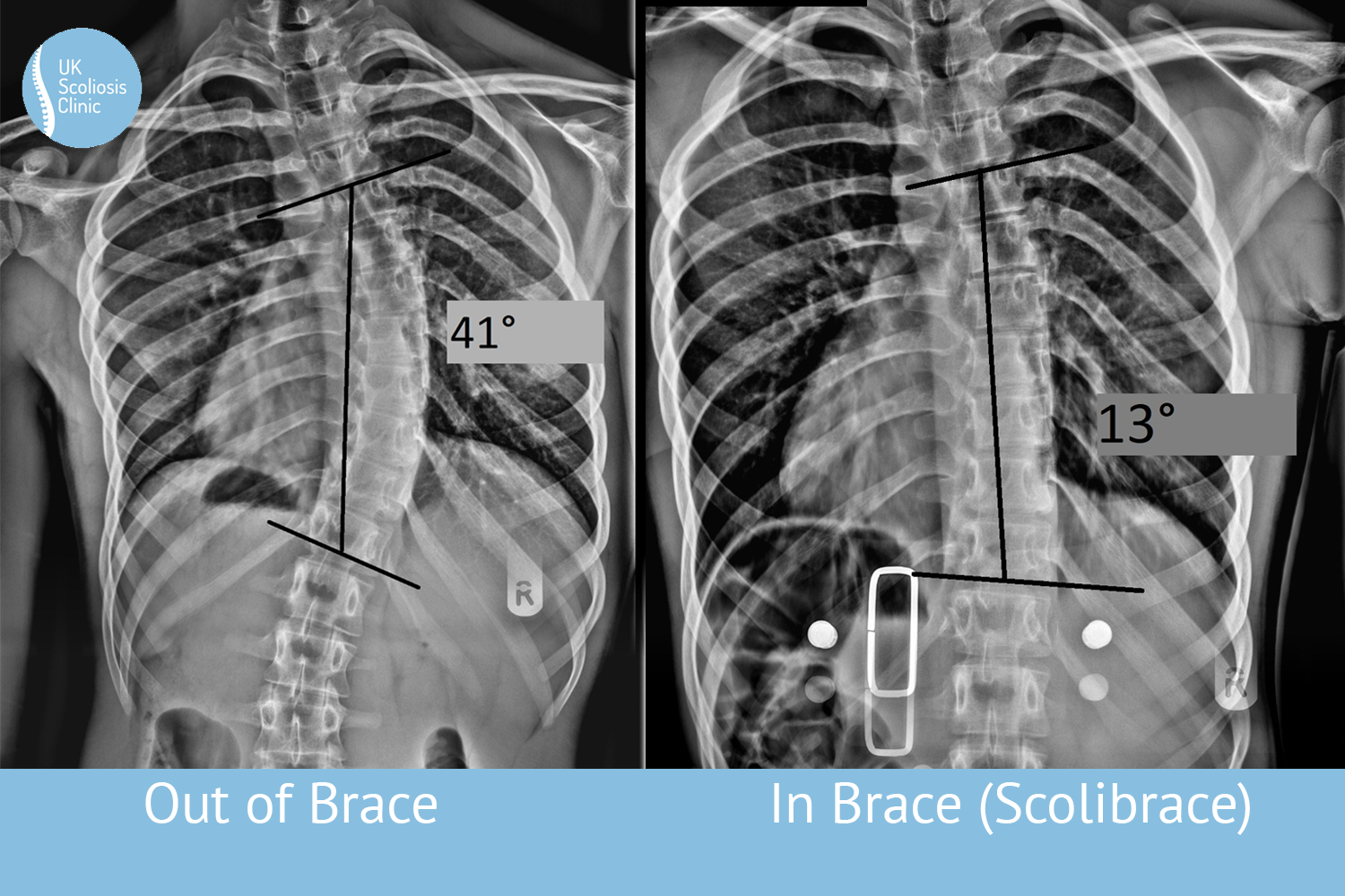 scolibrace Archives - Scoliosis Clinic UK - Treating Scoliosis