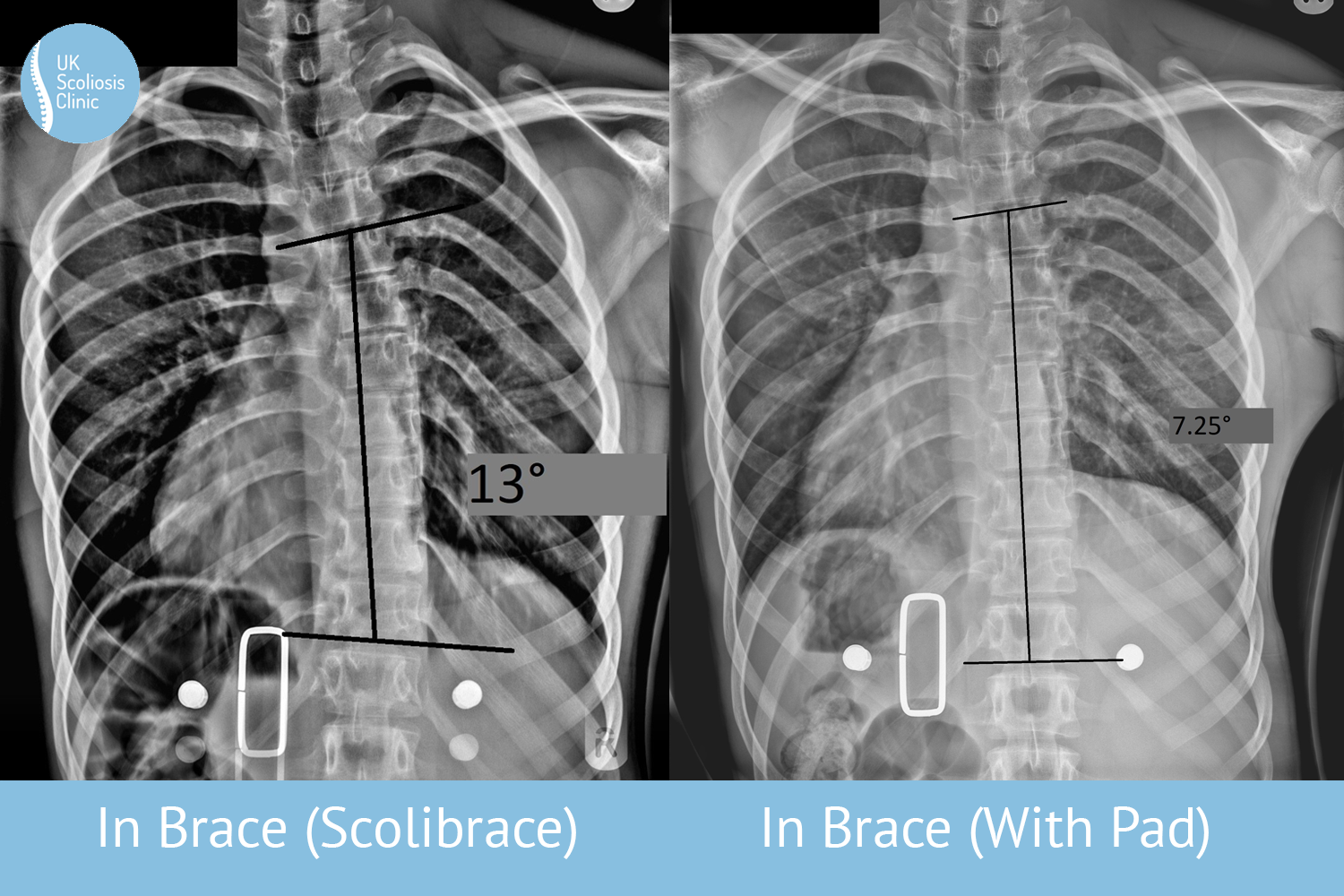 Superior in-brace correction achieved with a ScoliBrace