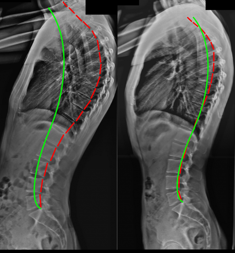 scoliosis-and-kyphosis-what-s-the-difference-scoliosis-clinic-uk