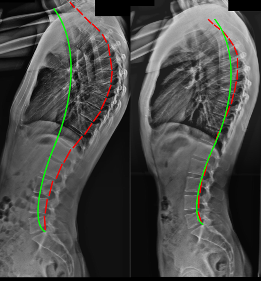 kyphosis Archives - Scoliosis Clinic UK - Treating Scoliosis without