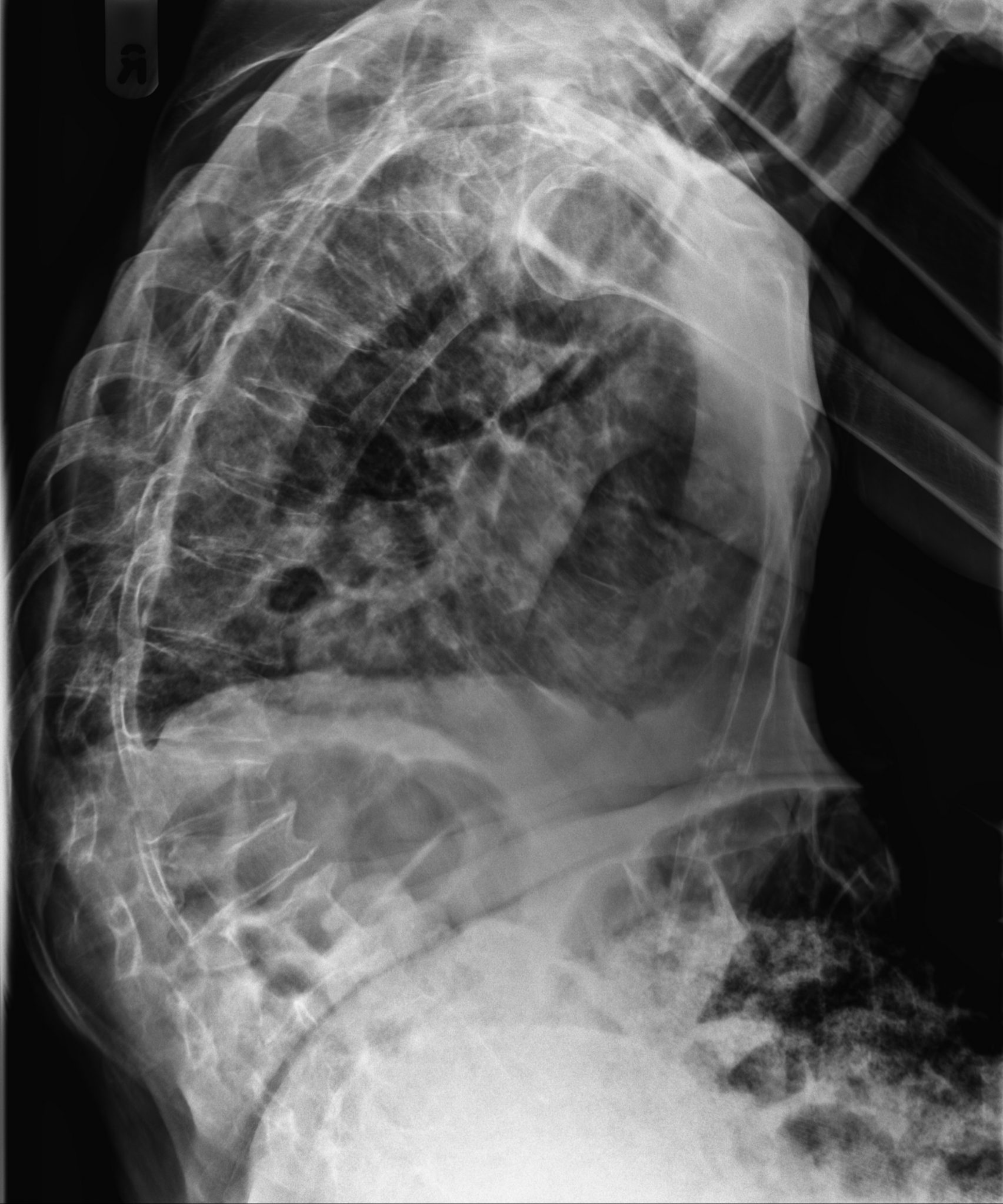 Scoliosis and Kyphosis, what's the difference? Scoliosis Clinic UK