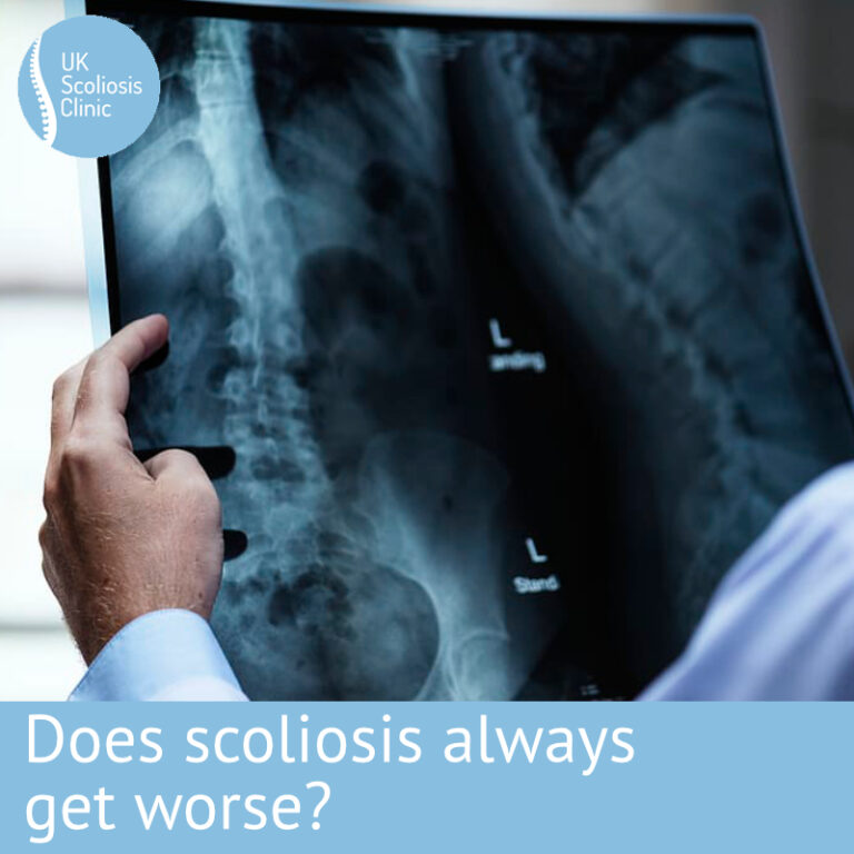 Does scoliosis always get worse? Scoliosis Clinic UK Treating