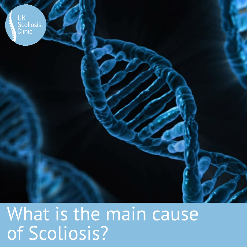 scoliosis cause Archives - Scoliosis Clinic UK - Treating Scoliosis without  surgery