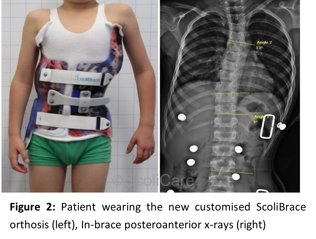 Scolibrace Vs. Hospital brace – which is better? - Scoliosis