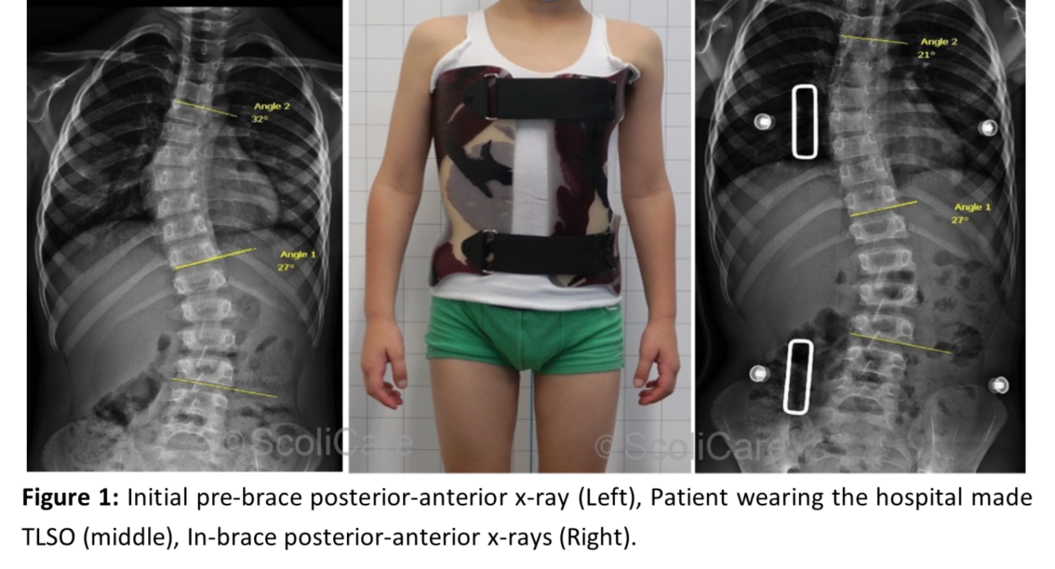 Scolibrace Vs. Hospital brace which is better? Scoliosis Clinic UK