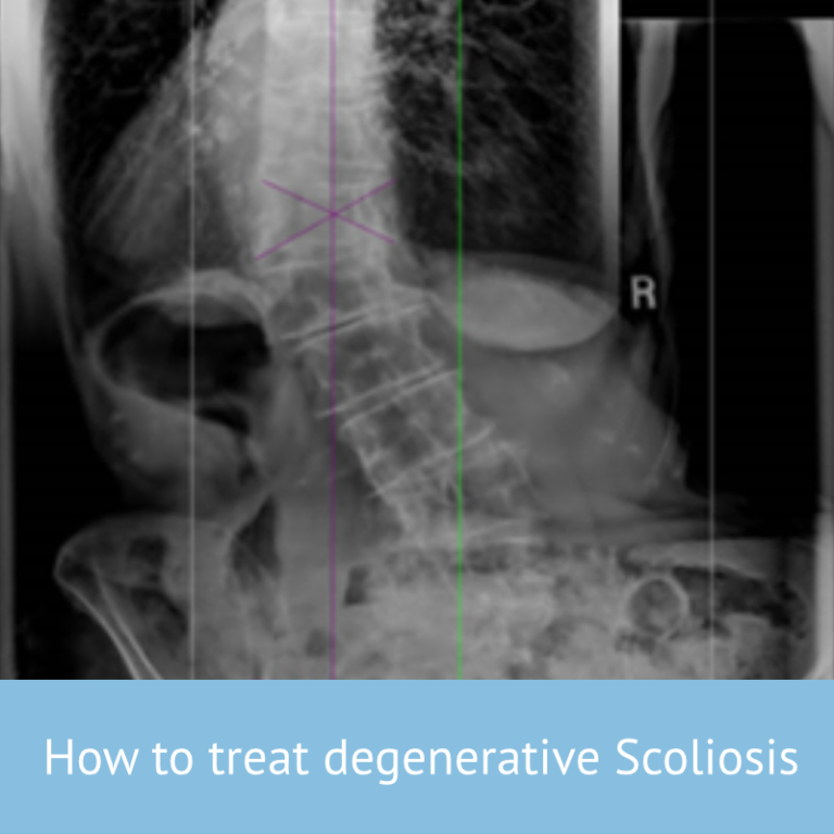 treatdegenscoli Scoliosis Clinic UK Treating Scoliosis without