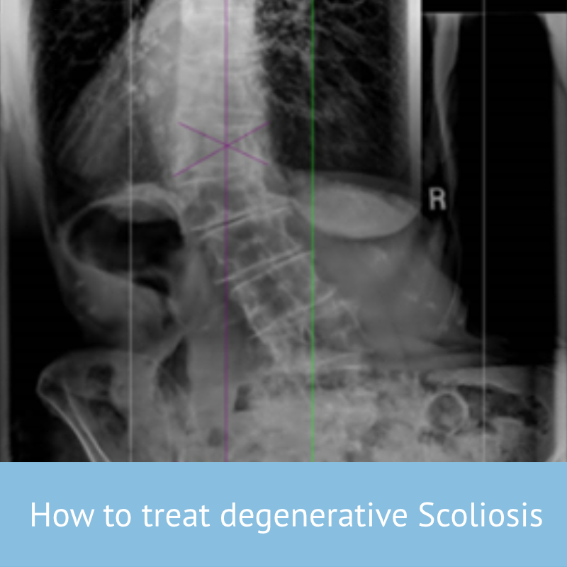 Types of ScoliBrace - Scoliosis Clinic UK - Treating Scoliosis without  surgery