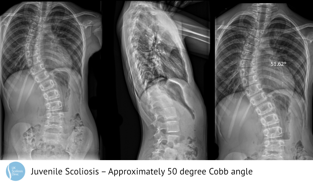 hospital brace Archives - Scoliosis Clinic UK - Treating Scoliosis without  surgery