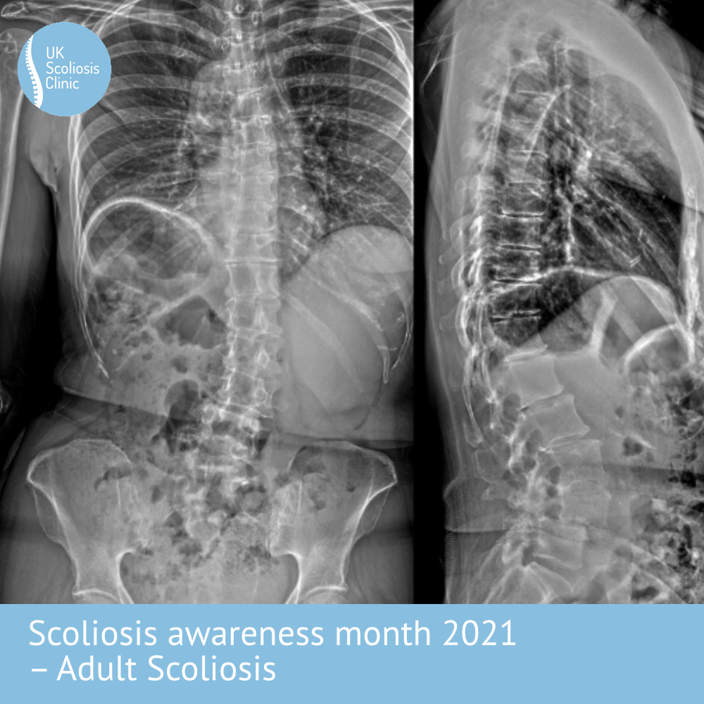 Types of ScoliBrace - Scoliosis Clinic UK - Treating Scoliosis