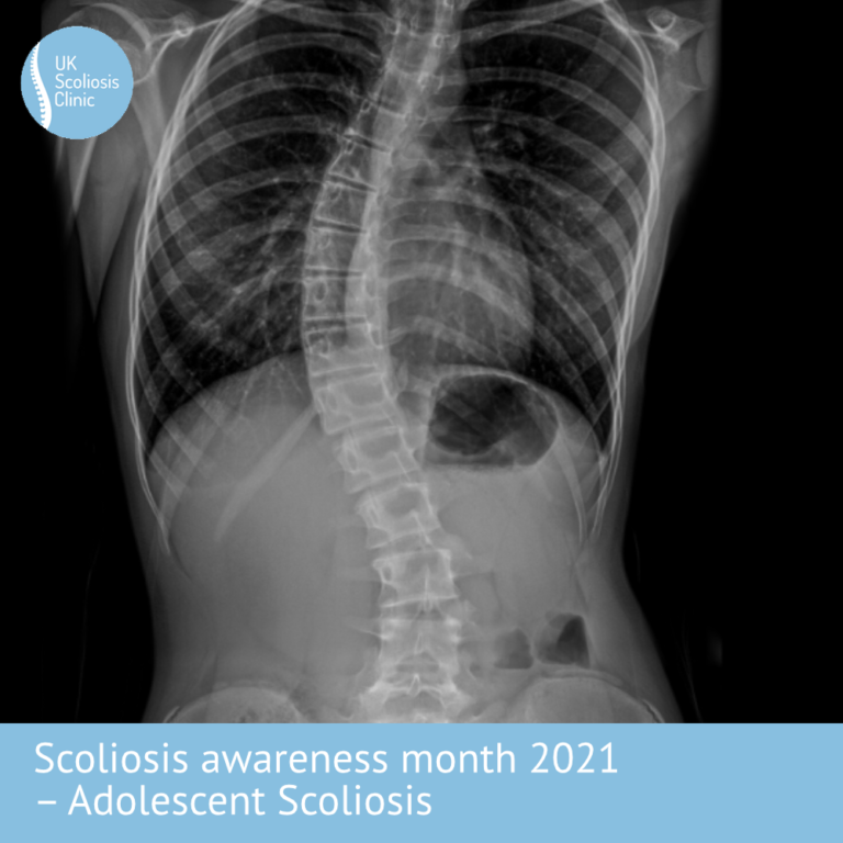 Scoli2021-ais - Scoliosis Clinic UK - Treating Scoliosis Without Surgery