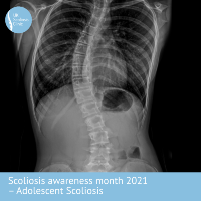 the uk scoliosis clinic treating scoliosis without surgery