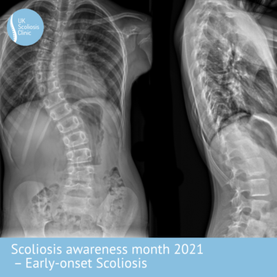 the uk scoliosis clinic treating scoliosis without surgery