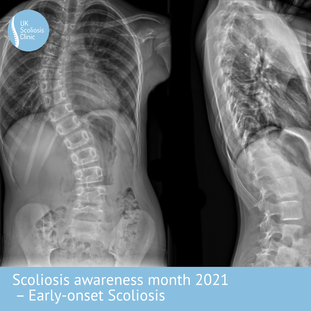 Rehab Core Physical Therapy - How to detect a Scoliosis and what to do if  you identify one? Scoliosis is a lateral curvature of the spine greater  than 10 degrees. When we