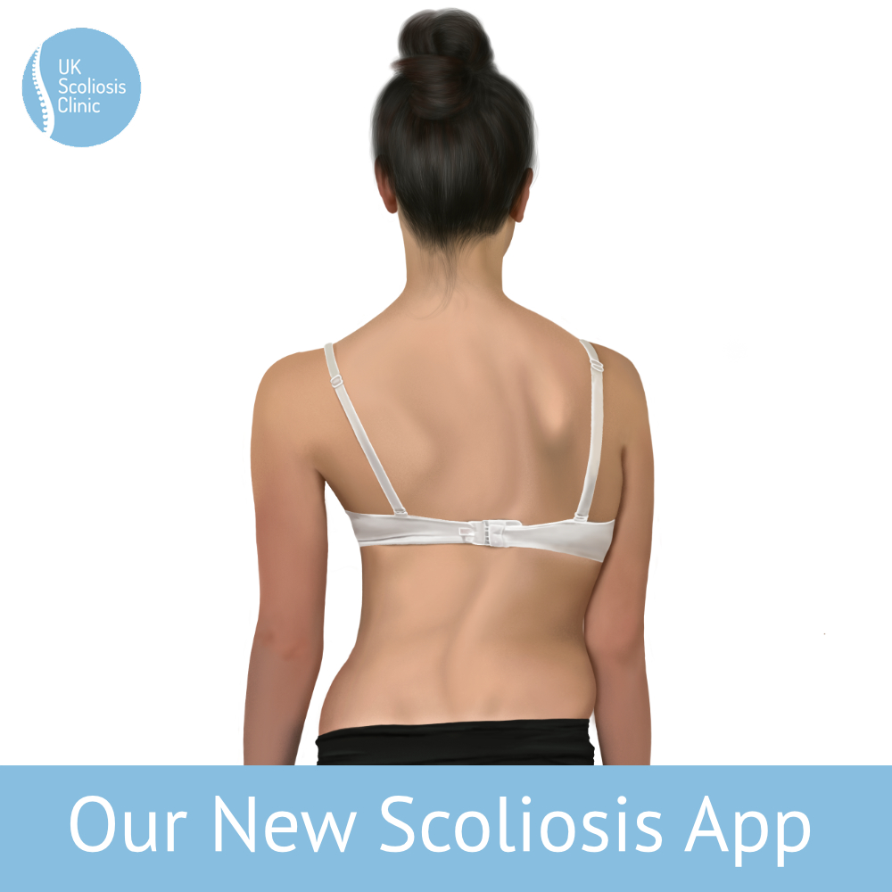 Our New App Scoliosis Clinic UK Treating Scoliosis Without Surgery