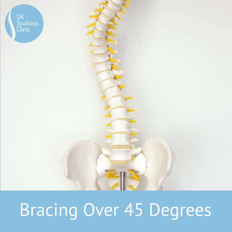 A brace to address functional 4-curve patterns for right thoracic and