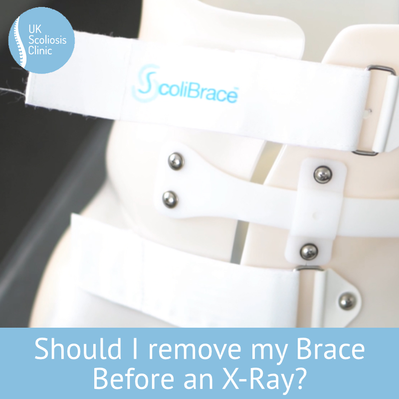 Corrective braces – Scottish National Spine Service